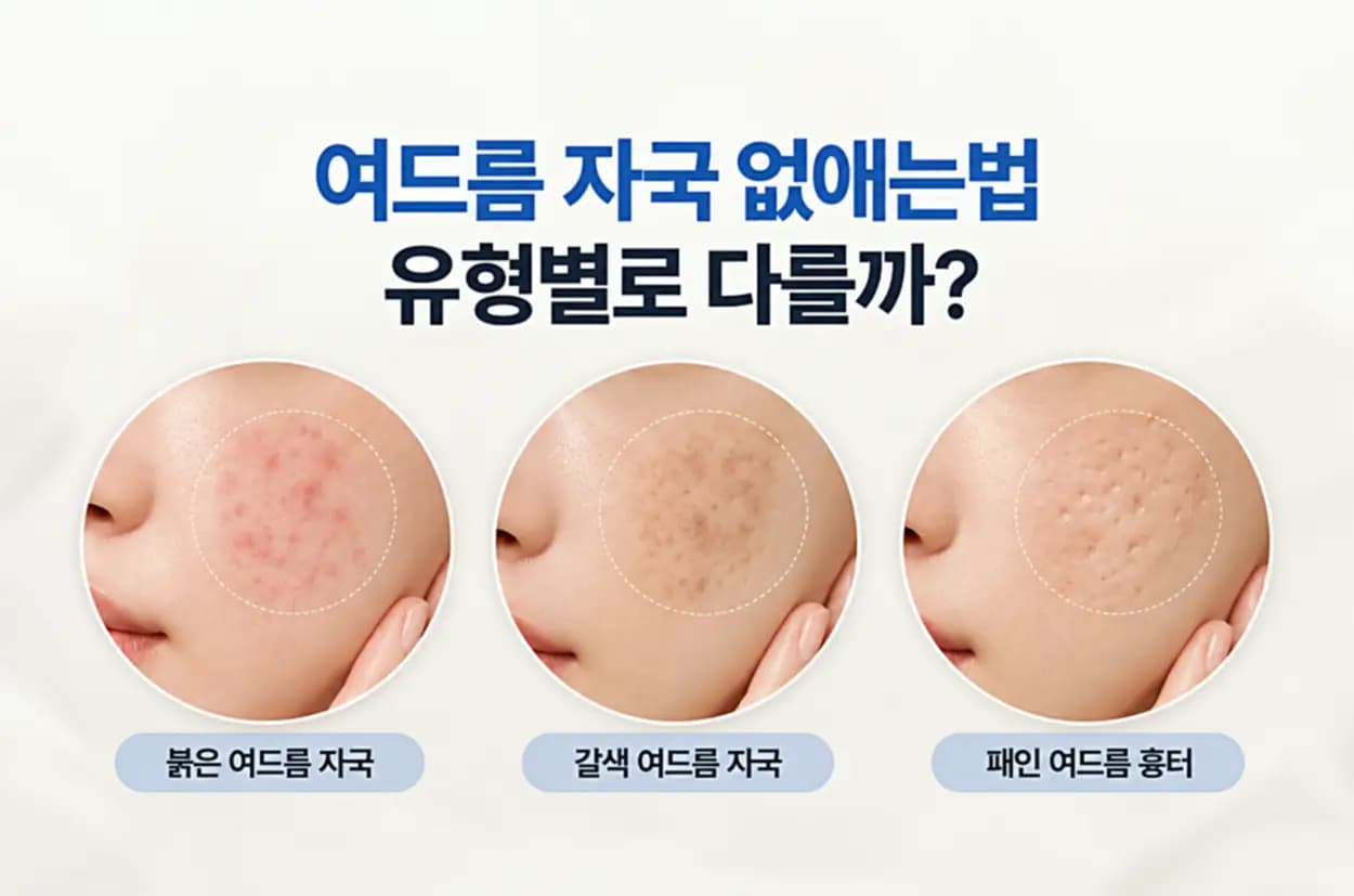 여드름 자국 유형별 비교 붉은 자국, 갈색 색소침착, 패인 여드름 흉터를 나타낸 썸네일 이미지