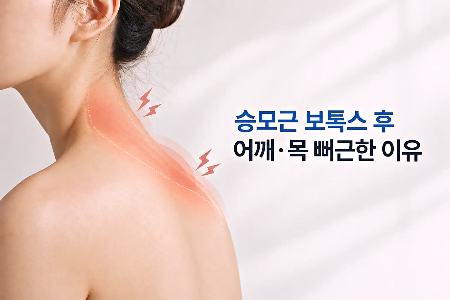 상부 승모근과 목과 어깨 부위를 크게 담아 승모근 보톡스 부작용 뻐근함을 설명한 썸네일