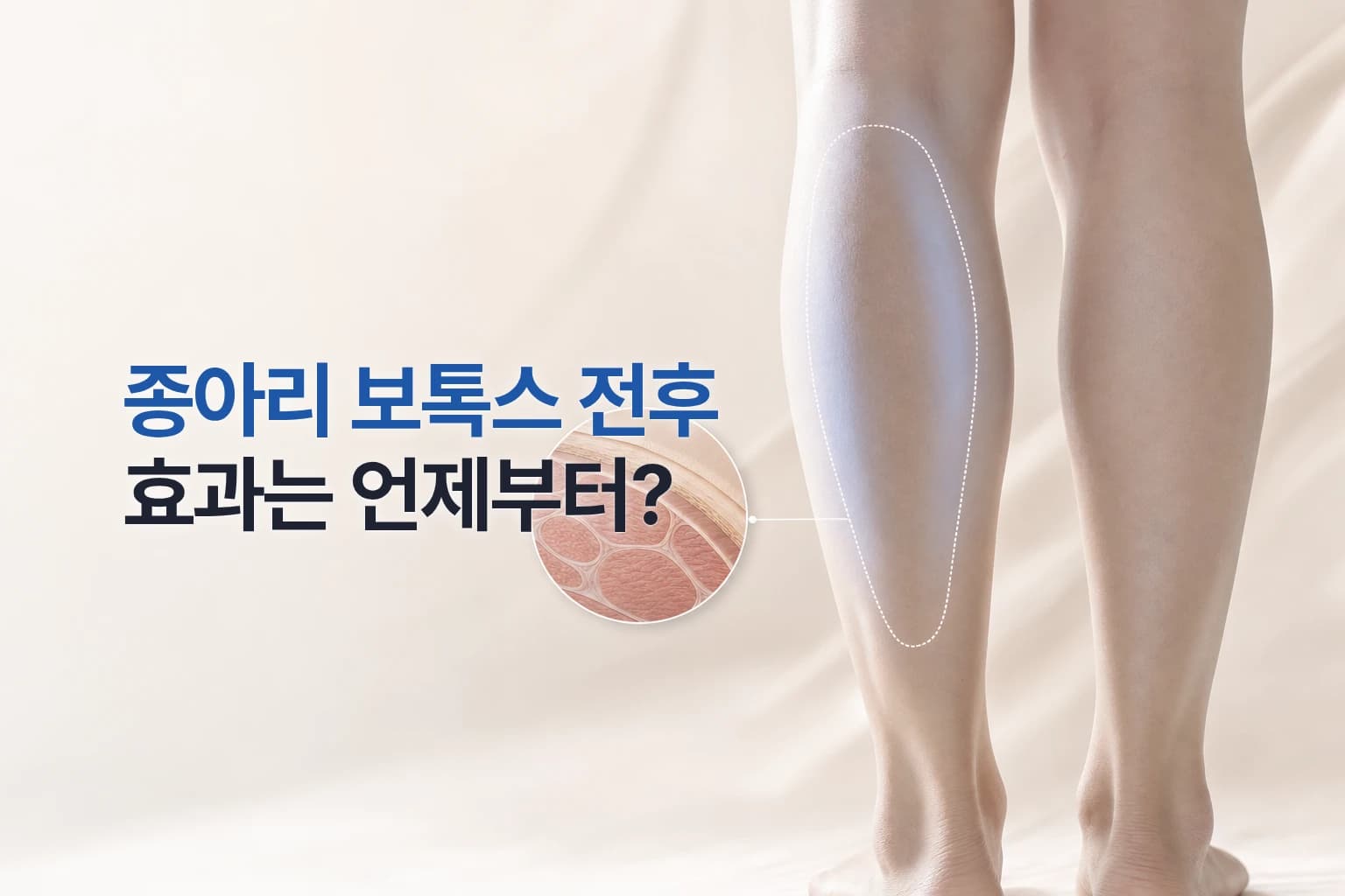 종아리 비복근을 점선으로 짚은 다리 사진과 근육 확대 인셋을 담은 종아리 보톡스 효과 시기 썸네일